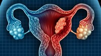 Ung thư nội mạc tử cung nguyên nhân dấu hiệu và giai đoạn phát triển